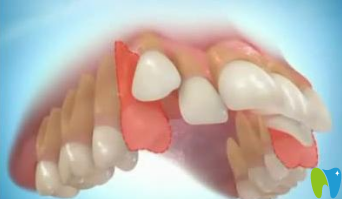 兒童在什么情況下矯正牙齒需要拔牙？拔牙矯正后會變松嗎