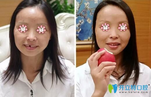 趙寶紅種植牙案例 趙寶紅種植牙案例