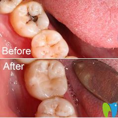 茂名致美補牙真人案例