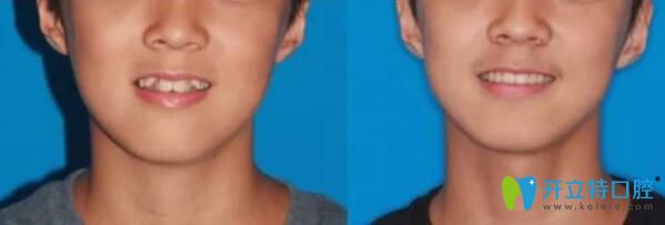 宋雪梅主任牙齒矯正案例 宋雪梅主任牙齒矯正案例