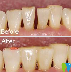 茂名致美牙周松動案例