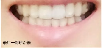 給大家看我在西安拜博口腔做的牙齒矯正日記，我在努力