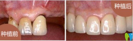 小白兔口腔全口缺失種植牙效果 小白兔口腔全口缺失種植牙效果
