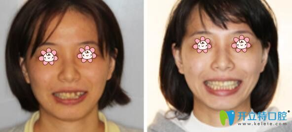 羅陽醫(yī)師牙齒修復(fù)案例