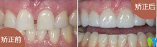 牙列稀疏、牙齒歪等矯正后效果對比圖