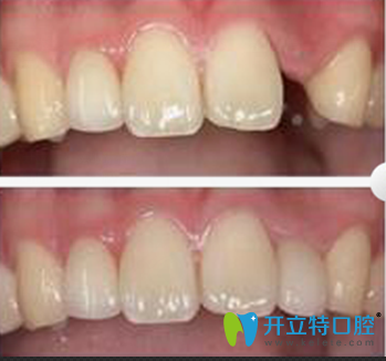 德陽新橋口腔種植牙案例