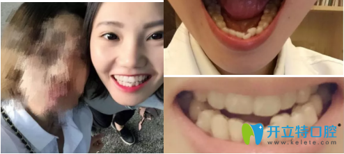 分享我在安拜博口腔做的牙齒矯正