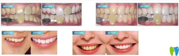 阜陽貝得口腔冷光美白牙齒案例