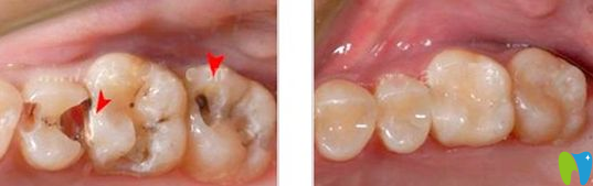 李耀陽(yáng)醫(yī)師齲病充填案例