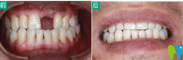 石家莊三博口腔種植牙前后效果圖