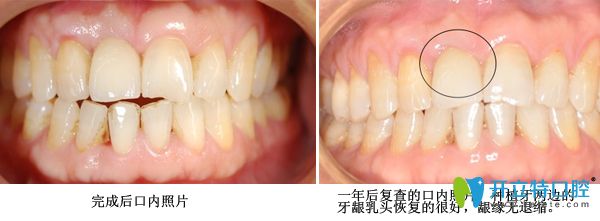 種植牙修復術后案例 種植牙修復術后案例