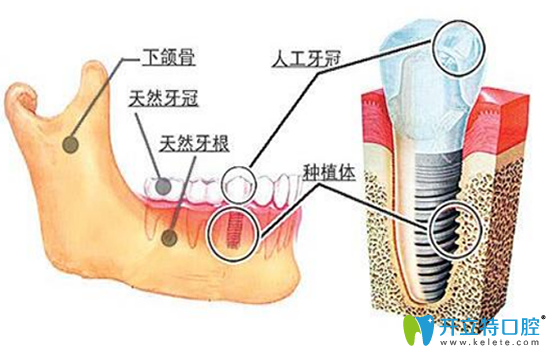 種植牙多少錢？哪些因素影響種植牙每一顆的價(jià)格？