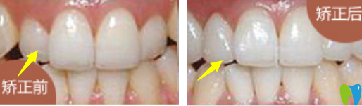 牙齒正畸效果對比圖