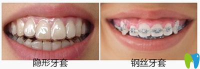 阜陽貝得口腔牙齒矯正案例