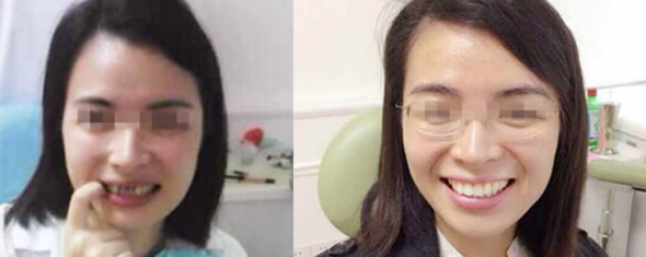 渭南小白兔口腔齙牙隱形矯正和牙齒缺損修復(fù)效果案例