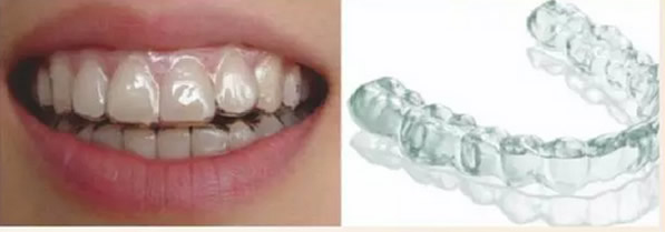 渭南小白兔口腔矯正牙齒的方法有哪些 都適合哪些人群