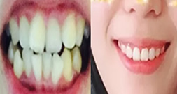 成人牙齒矯正要多久?曬晉中潤(rùn)芽口腔做牙齒矯正10個(gè)月變化