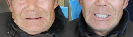 徐州博愛口腔牙科醫(yī)生為71歲老人進(jìn)行全口活動(dòng)義齒修復(fù)