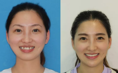 西安雁塔海濤口腔做的牙齒矯正手術(shù)，講講我有多痛苦