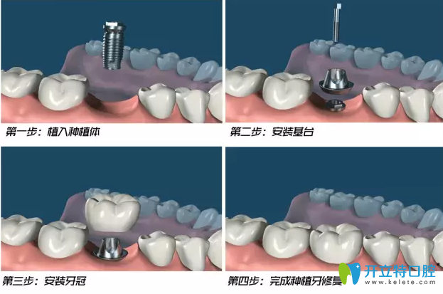 郴州植貝爾口腔種植牙過程 郴州植貝爾口腔種植牙過程