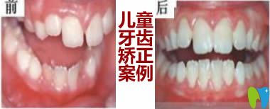 兒童牙齒正畸前后對(duì)比案例