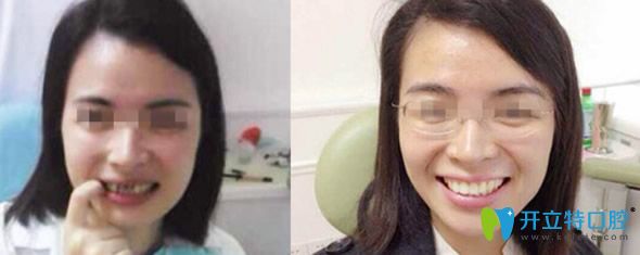 渭南小白兔口腔牙齒缺損+色素牙修復(fù)效果 渭南小白兔口腔牙齒缺損+色素牙修復(fù)效果