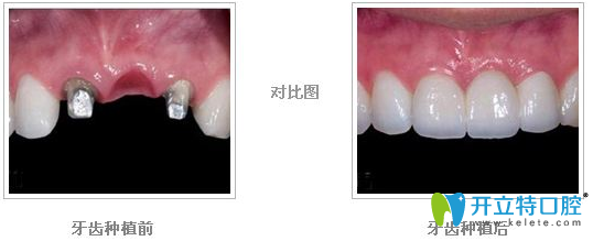 廣州圣貝口腔口腔種植醫(yī)生王運(yùn)法牙齒種植案例對比圖