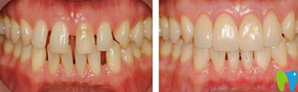 宏沅膛口腔牙齒矯正效果圖 宏沅膛口腔牙齒矯正效果圖