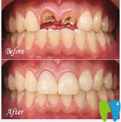 廣州暨博口腔潘廣嗣門牙顆牙缺失種植案例對比圖 廣州暨博口腔潘廣嗣門牙顆牙缺失種植案例對比圖