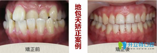 地包天牙齒矯正前后對(duì)比圖