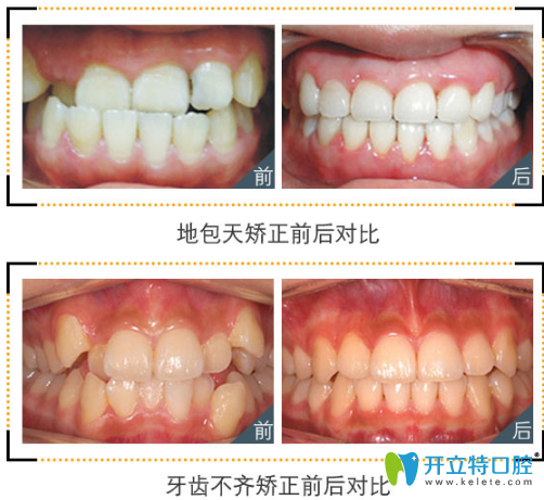 郴州植貝爾口腔牙齒矯正案例 郴州植貝爾口腔牙齒矯正案例
