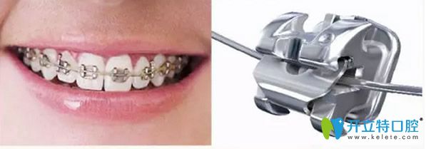 自鎖托槽矯正器 自鎖托槽矯正器