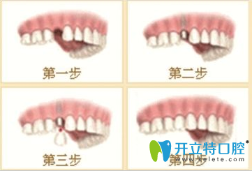 拜博拜爾口腔種植牙介紹 拜博拜爾口腔種植牙介紹