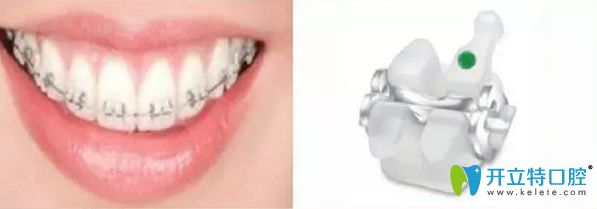 陶瓷托槽矯正 陶瓷托槽矯正