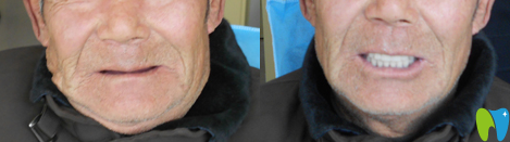 徐州博愛口腔全口活動義齒修復(fù)案例前后效果 徐州博愛口腔全口活動義齒修復(fù)案例前后效果