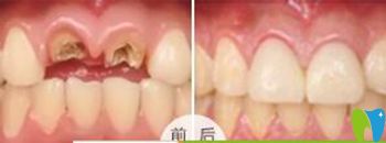 <!--<i data=20240703-sp></i>-->口腔做門牙缺失種植牙修復(fù)