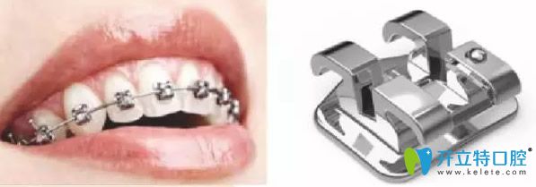 普通金屬托槽牙齒矯正 普通金屬托槽牙齒矯正