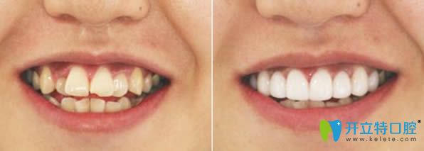 撫順牙齒矯正哪家醫(yī)院好，先來看下瑞德口腔的正畸案例吧