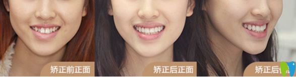 渭南小白兔口腔牙齒矯正案例 渭南小白兔口腔牙齒矯正案例