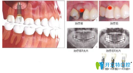 巴彥淖爾瑞欣口腔資深牙醫(yī)良心告白:種植牙并非鑲牙