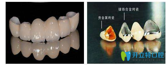 假牙主要常用的材料 假牙主要常用的材料