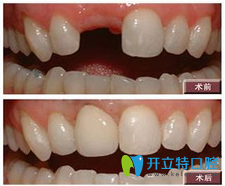 拜博拜爾口腔種植牙效果圖 拜博拜爾口腔種植牙效果圖