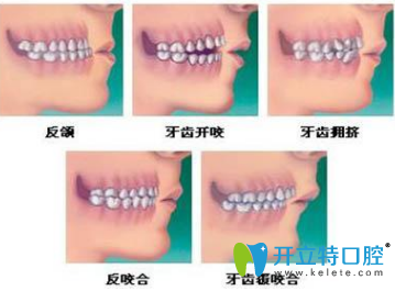 兒童矯正牙齒有哪幾個(gè)年齡段？有幾種矯牙齒的方法？