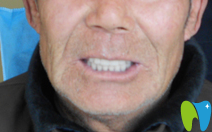 徐州博愛口腔全口活動義齒修復(fù)后照片 徐州博愛口腔全口活動義齒修復(fù)后照片