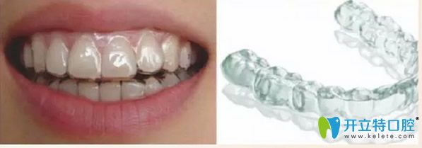 無托槽隱形矯正 無托槽隱形矯正