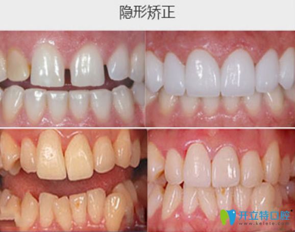 晉中潤(rùn)芽口腔牙齒矯正案例對(duì)比圖