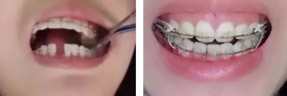 門牙缺失、齙牙怎么辦 看孝感口腔牙齒種植和矯正案例