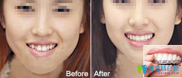 時(shí)代天使隱形牙齒正畸前對比圖 時(shí)代天使隱形牙齒正畸前對比圖
