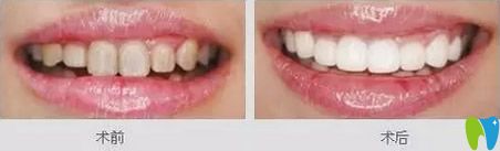 孝感口腔皓齒美白案例