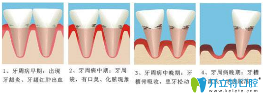 牙周炎的過程